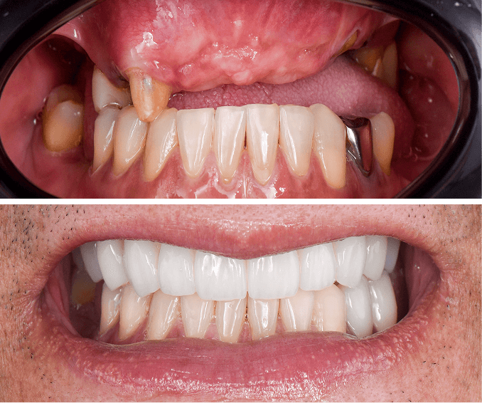 Comparison of teeth before and after dental treatment showing damaged and missing upper front teeth filled with dental implants and brighter, restored teeth after treatment.