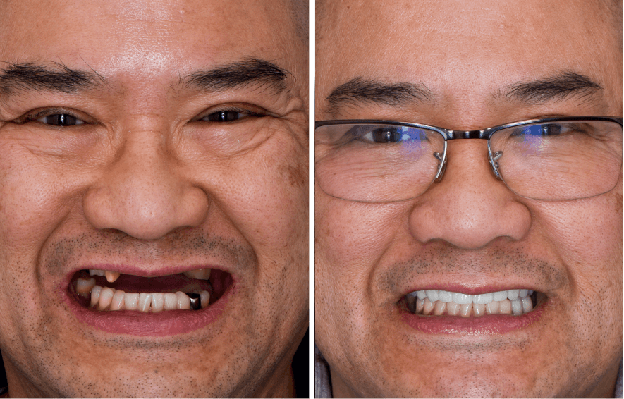 Side-by-side before and after close-up of a man’s face showing dental transformation, with missing and damaged teeth on the left and a full set of white teeth with glasses on the right.