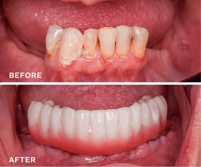 Before and after comparison of teeth showing severely decayed, discolored upper front teeth replaced with clean, white, and even dentures.