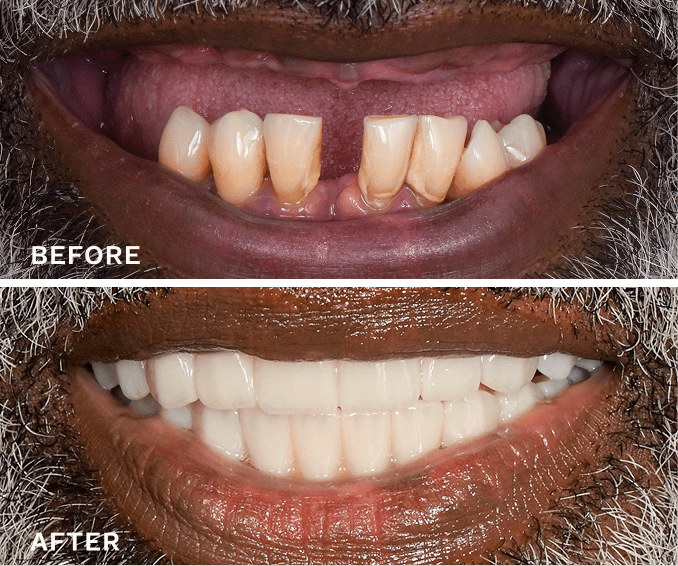 Before and after close-up images of a person's mouth showing severely worn and missing upper front teeth transformed to a full set of straight, white teeth with a bright smile.