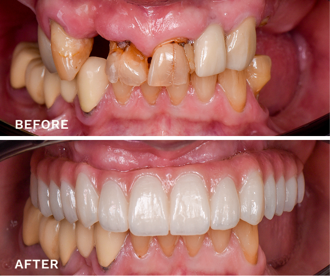 Close-up comparison of teeth showing a dental transformation with severely decayed and missing upper front teeth before, and a full set of clean, white upper front teeth after dental restoration.