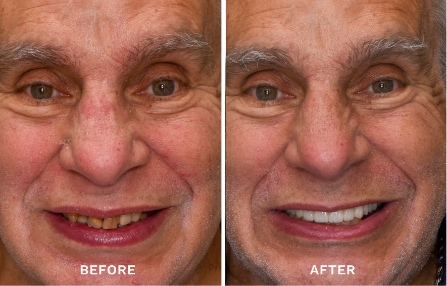 Side-by-side close-up of an elderly man's face showing before and after dental treatment; the left image shows stained and missing teeth, and the right image shows clean, complete white teeth.