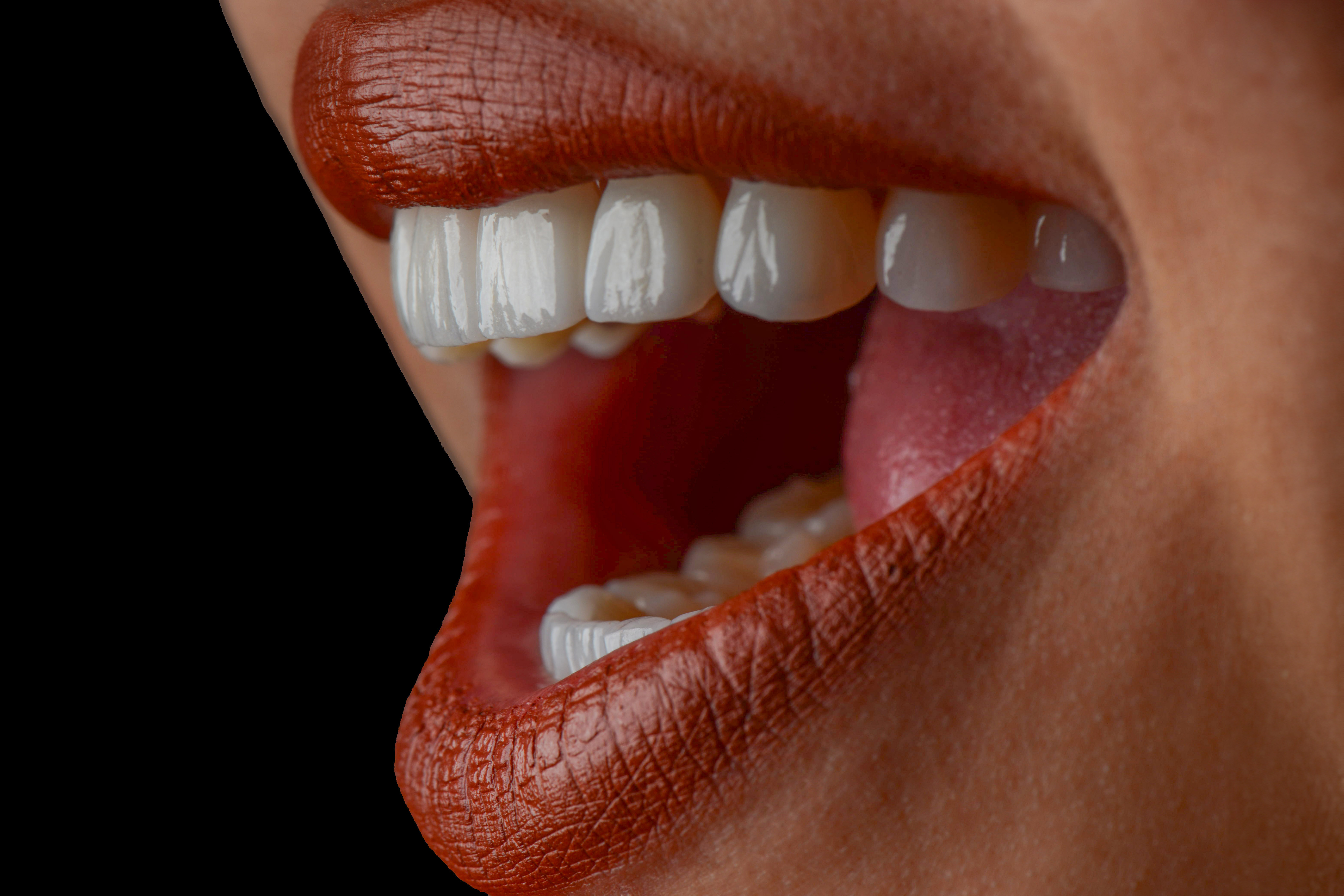 Composite Veneers/Bonding