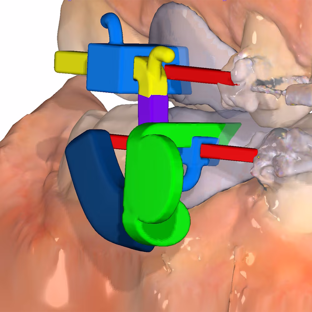 3-D-Darstellung der bewährten M.A.R.A.-Funktion, direkt in OnyxCeph³™ mit OrthoApps 3D-Modul.