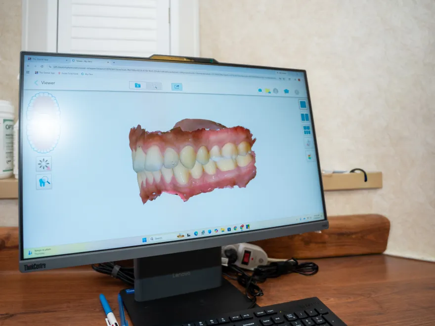 Computer screen showing a 3D digital model of upper and lower teeth in dental software.