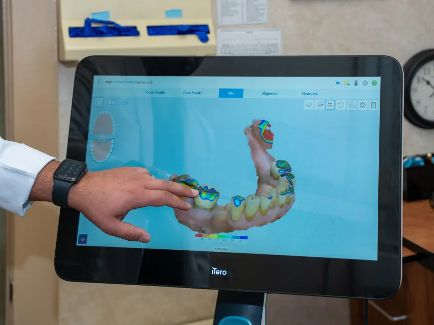 Hand pointing at a 3D digital model of a lower jaw showing bite pressure on a dental scanner screen.