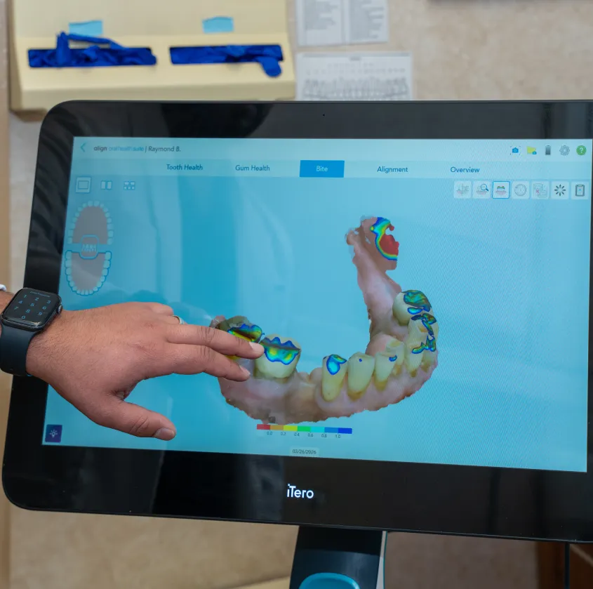 Hand pointing at digital 3D model of lower teeth with color-coded bite analysis on a screen.