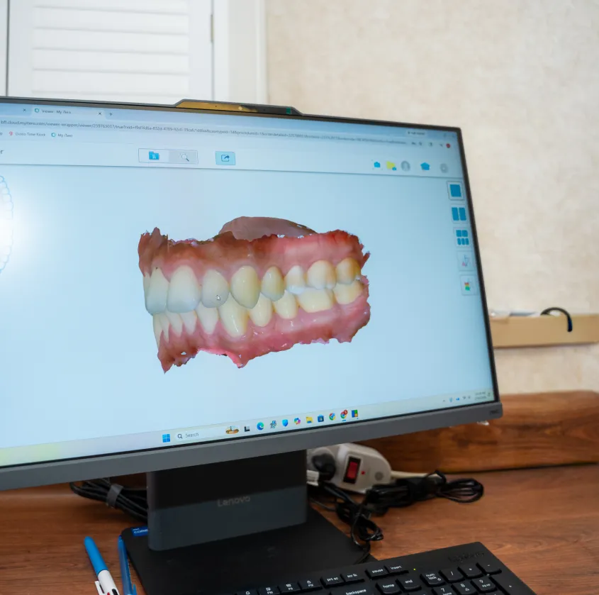 Computer screen showing a 3D digital model of human teeth and gums for dental analysis.