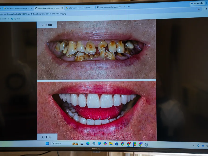 Before and after close-up of mouth showing severely decayed teeth replaced with clean, white dental implants.