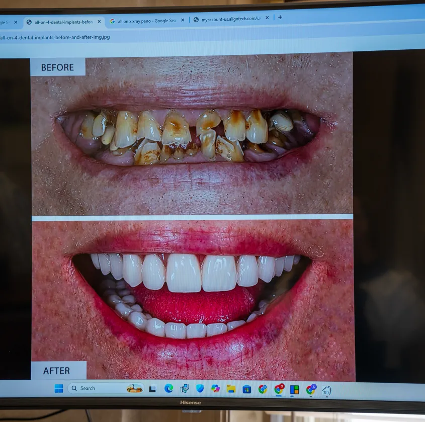Before and after close-up of a person's mouth showing decayed teeth versus white dental implants.