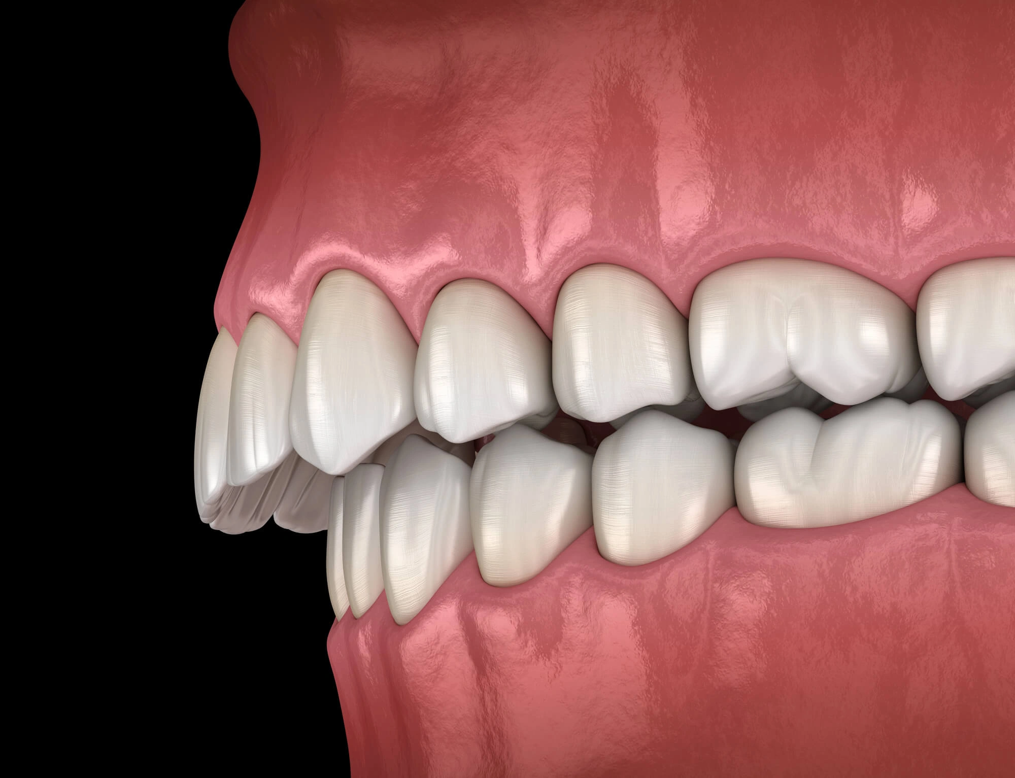 Overbite illustration by orthodontist west chester pa