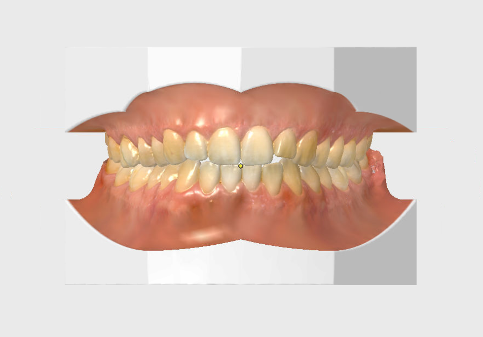 3D-Darstellung eines geschlossenen menschlichen Gebisses mit Zähnen und Zahnfleisch.