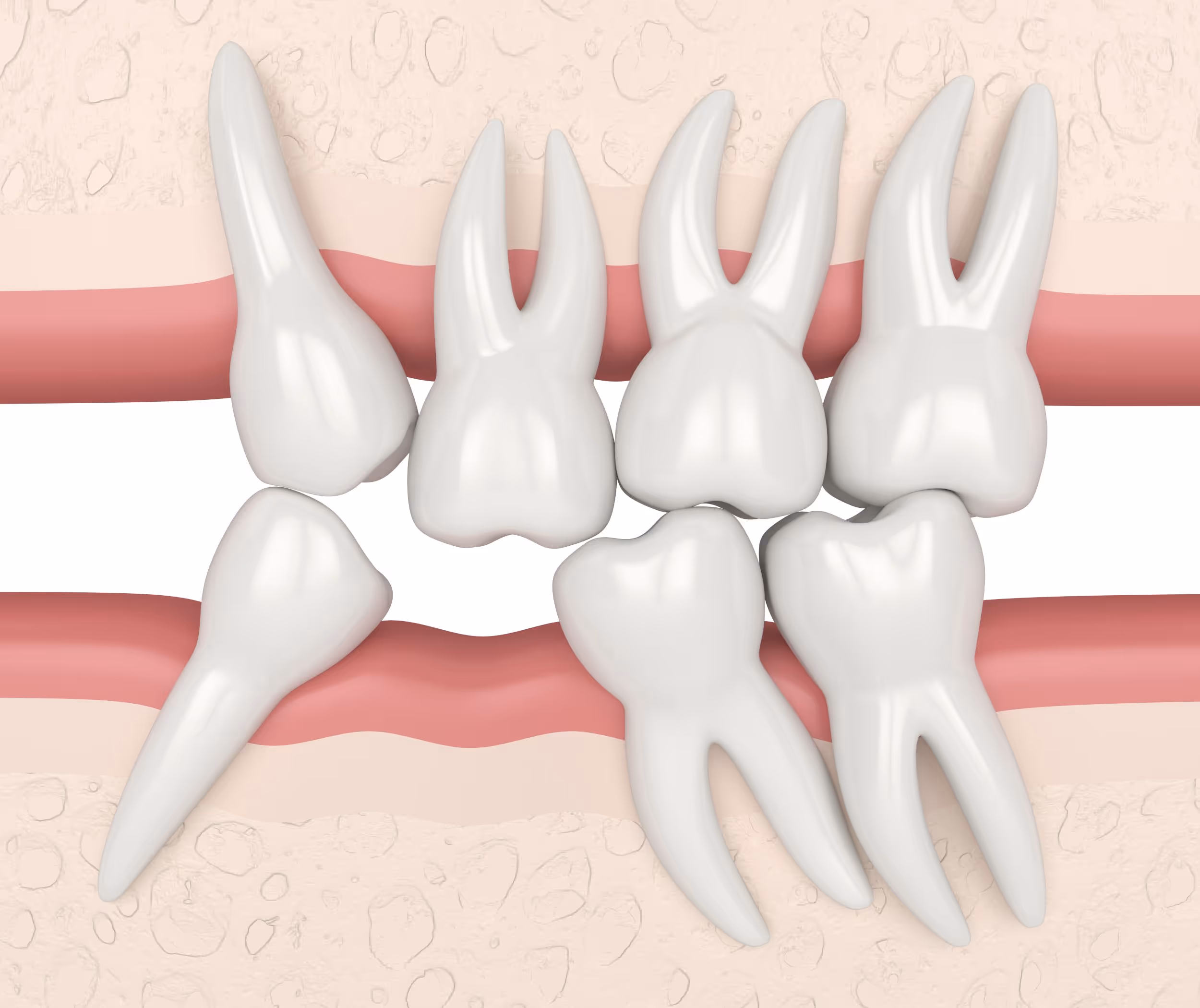 Schematische Darstellung von Zähnen, die in eine Zahnlücke wandern.