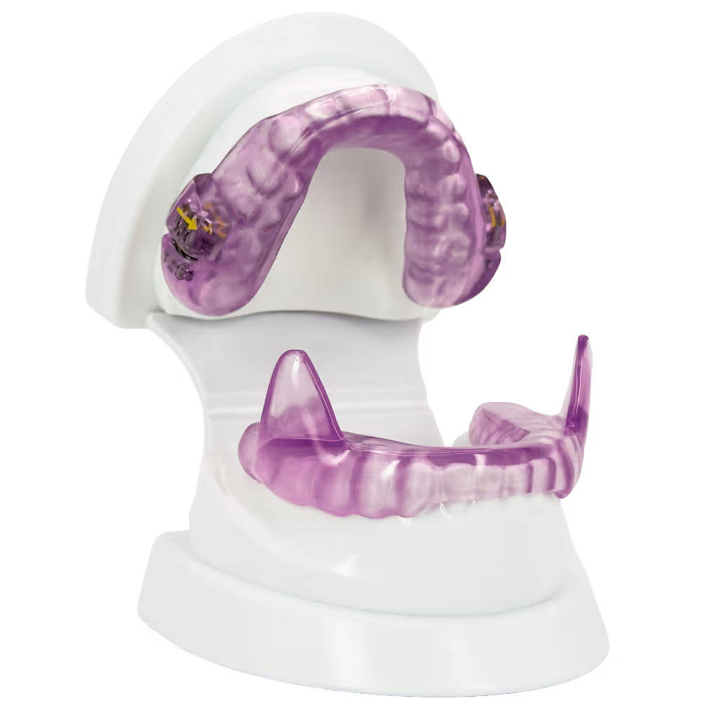 Lila Schnarcherschiene auf weißem Zahnmodell zur Behandlung von Schnarchen. Kiefern im Modell geöffnet.