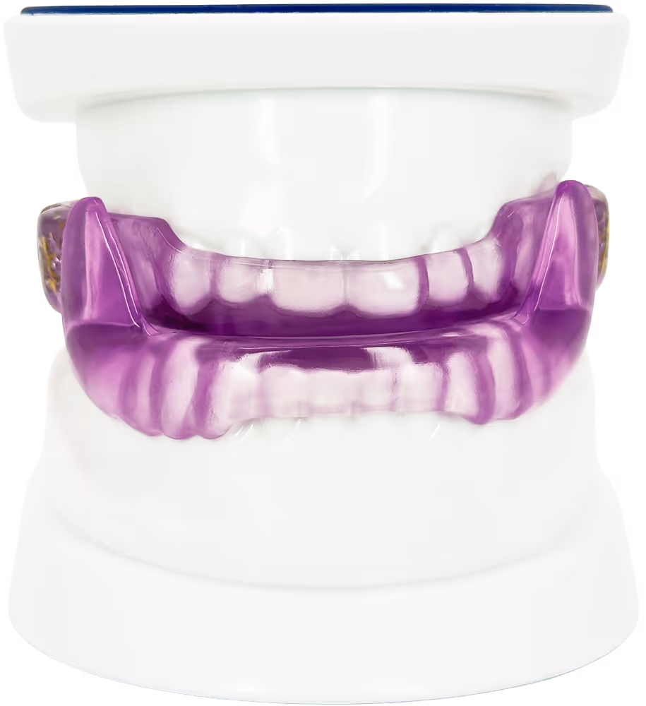 Lila Schnarcherschiene auf weißem Zahnmodell zur Behandlung von Schnarchen. Frontale Ansicht.