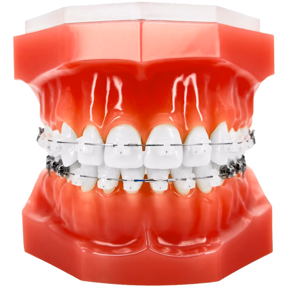 Zahnmodell mit oberer und unterer Zahnreihe, beide mit fester Zahnspange. Frontzähne mit weißen Keramik-Brackets.