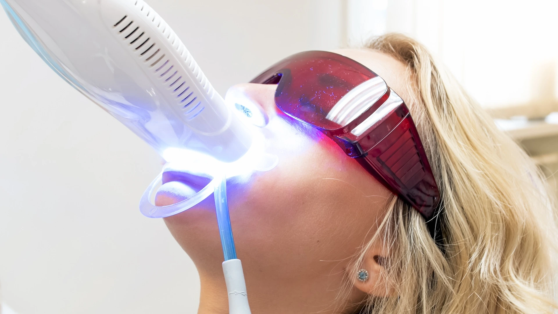 Achieve a Brighter Smile: Professional Teeth Whitening Options and Results in Rancho Cucamonga