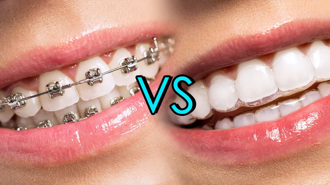 Understanding Invisalign and Traditional Braces