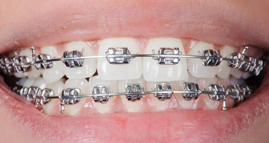 Traditional braces have been a trusted orthodontic treatment
