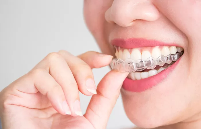 Invisalign is a modern orthodontic system
