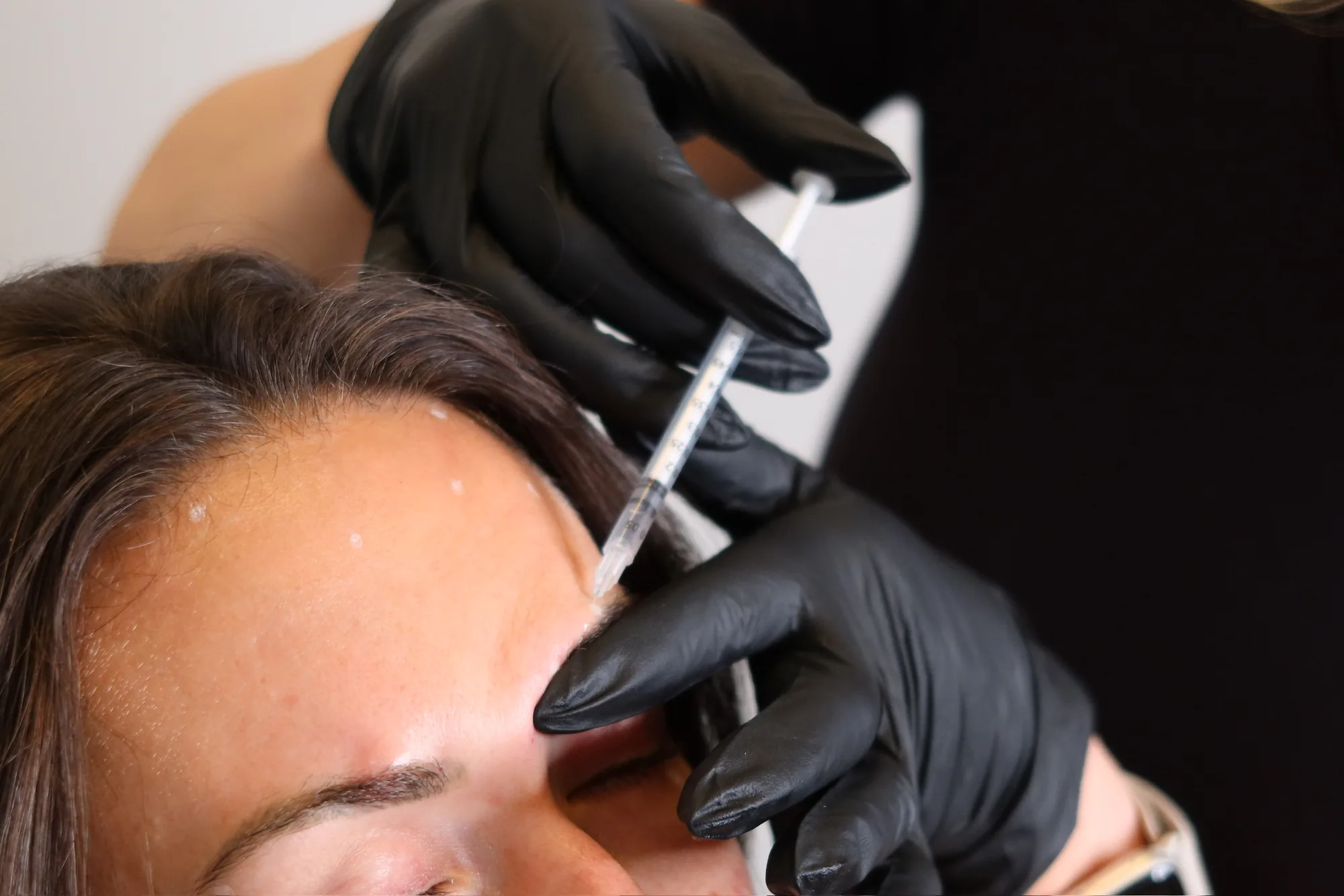 Close-up of a gloved injector placing Botox in a client's forehead
