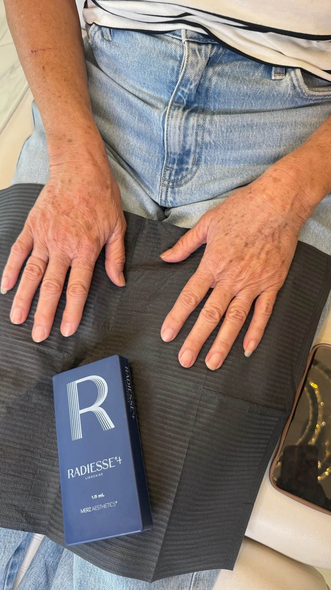 Client's hands resting on a drape beside a box of Radiesse+ for hand rejuvenation.