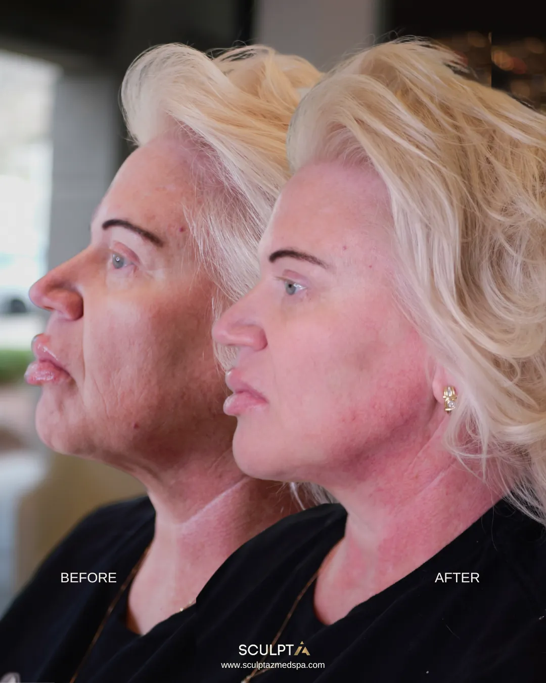 Side profile before and after Radiesse treatment at Sculpt AZ, showing a smoother lower face and jawline.
