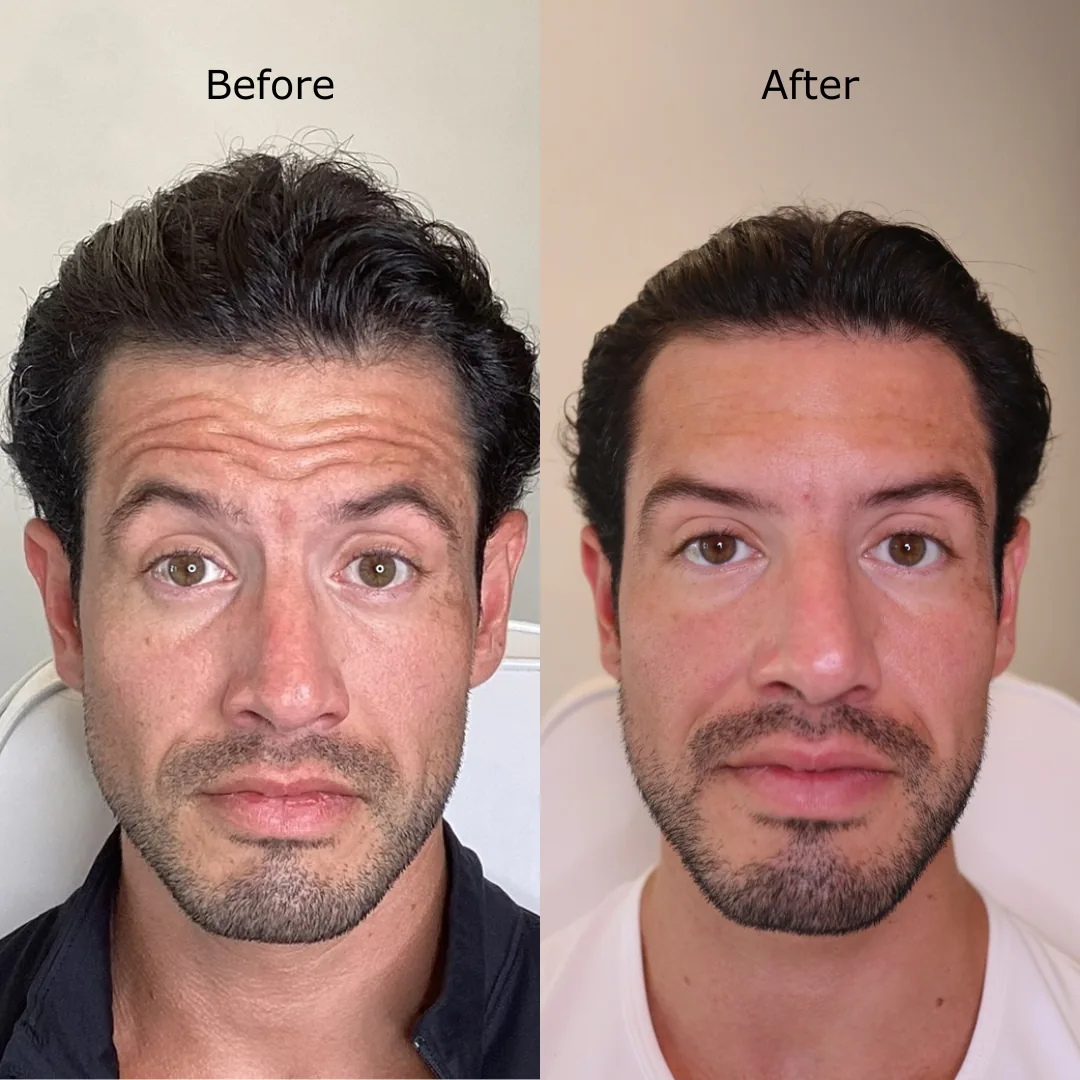 Botox before and after at Sculpt AZ: man's deep forehead lines before treatment and a smooth forehead after.