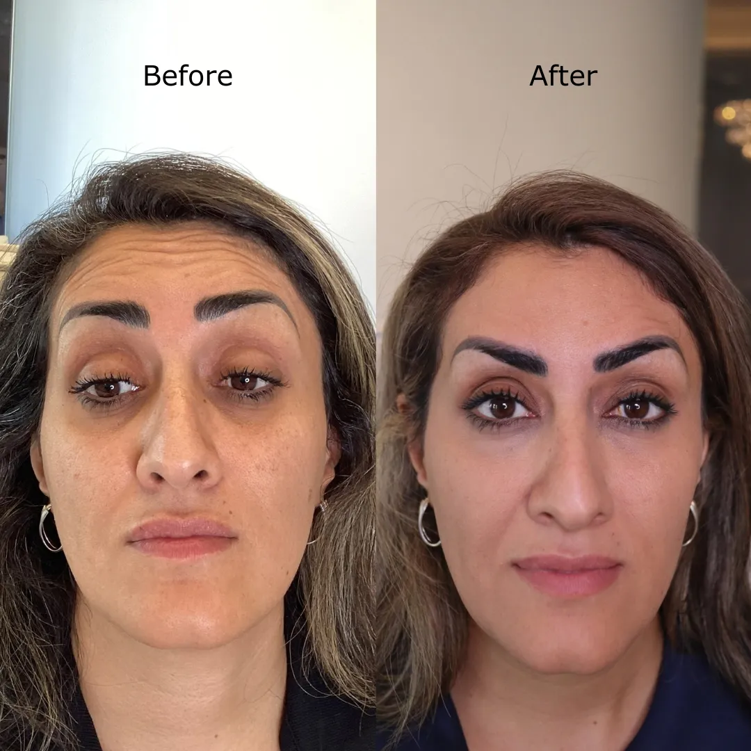 Botox before and after at Sculpt AZ: woman's forehead lines before treatment and a smoother forehead after.