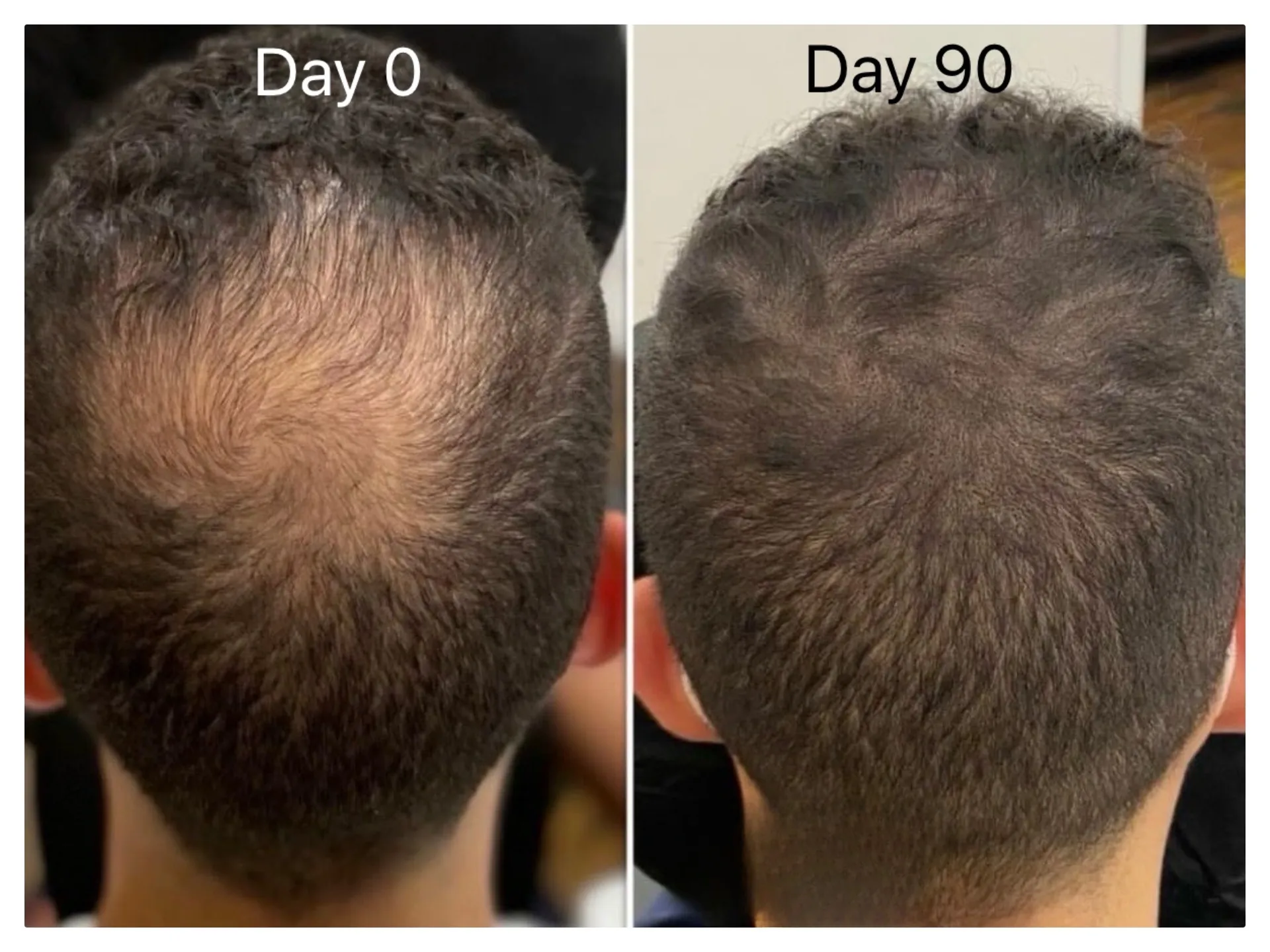 Exoscalp before and after: man's crown whorl at day 0 and day 90, with less visible scalp.