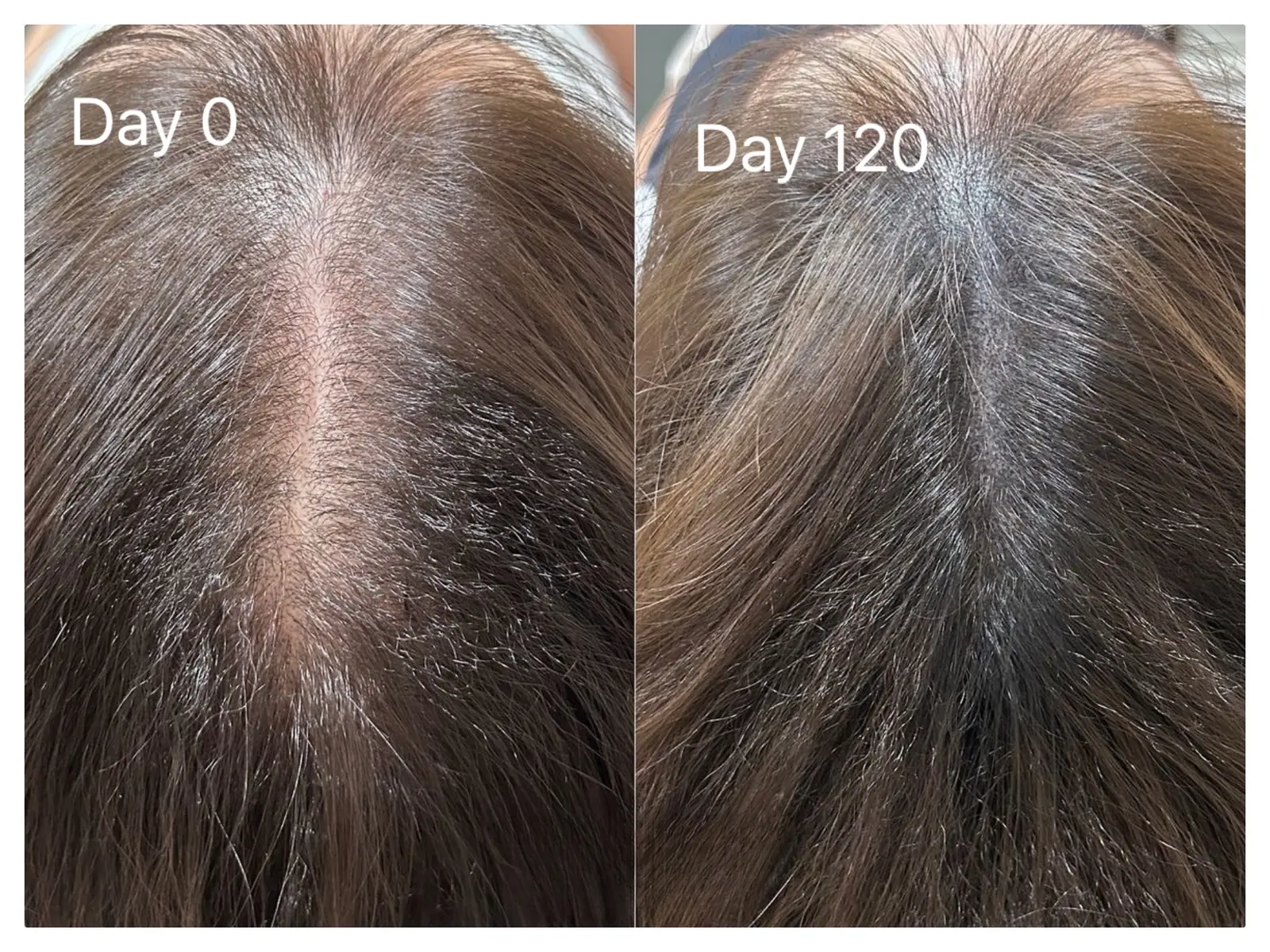 Exoscalp before and after: woman's center part at day 0 and day 120, appearing narrower and denser.