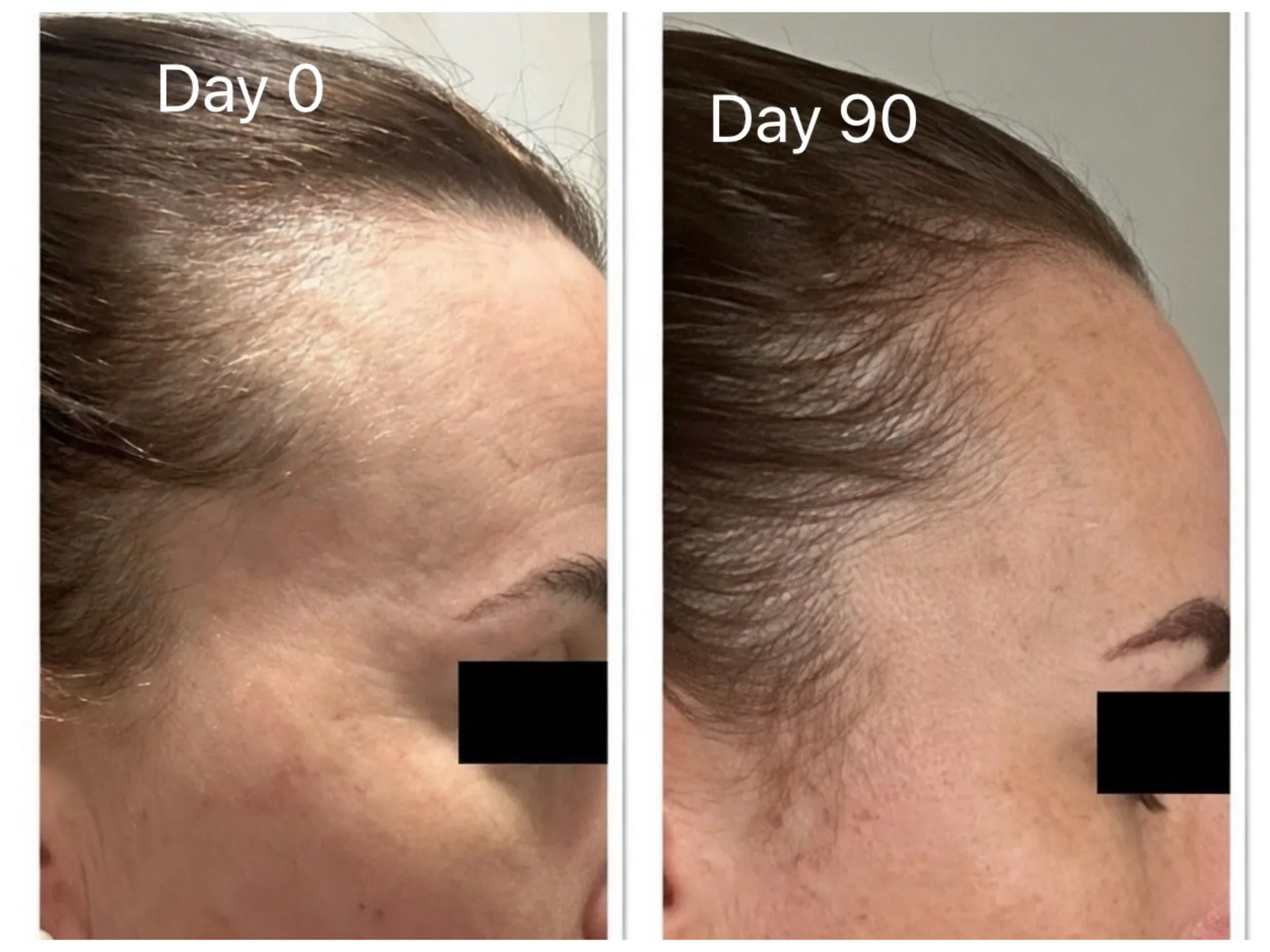 Exoscalp before and after: woman's receded temple at day 0 and fuller coverage along the hairline at day 90.