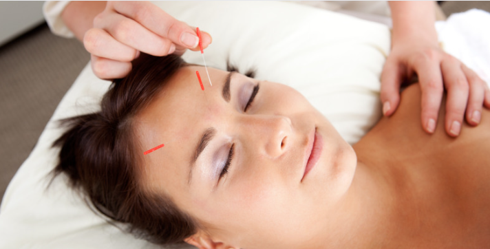Acupuncture Techniques