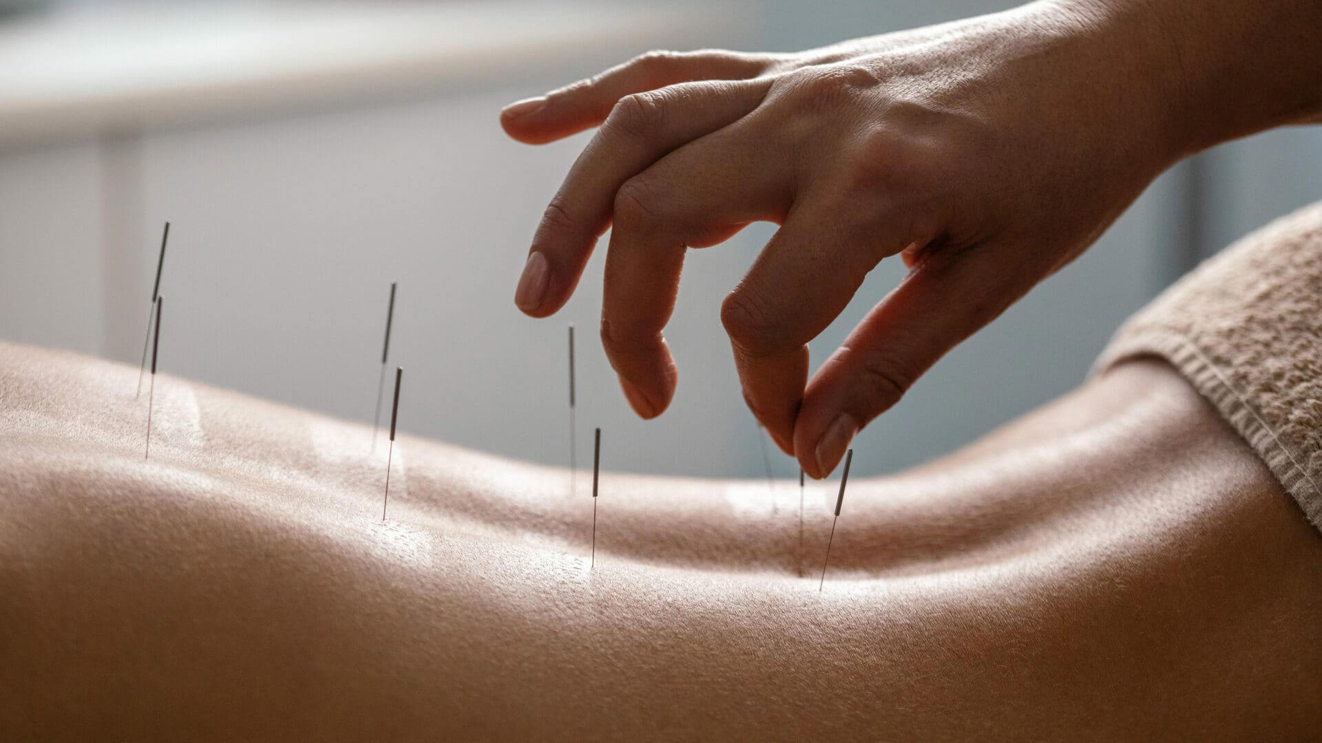 Acupuncture Therapy at Amersham Wellness Co.