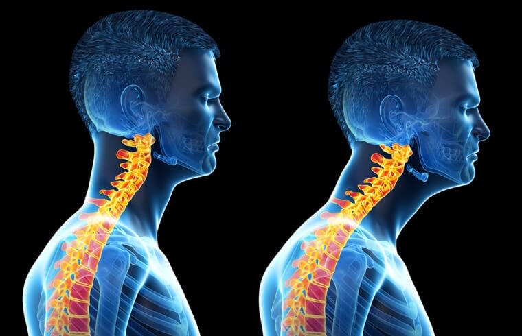 Side-by-side medical illustrations of the neck and upper spine, showing two lateral views.