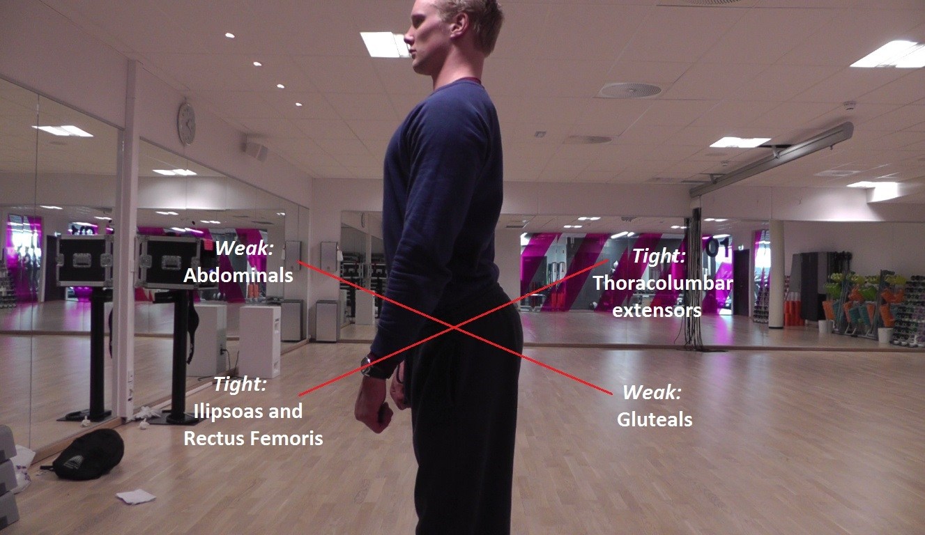 Side view of a standing person annotated with weak abdominals and gluteals, and tight hip flexors and back extensors.