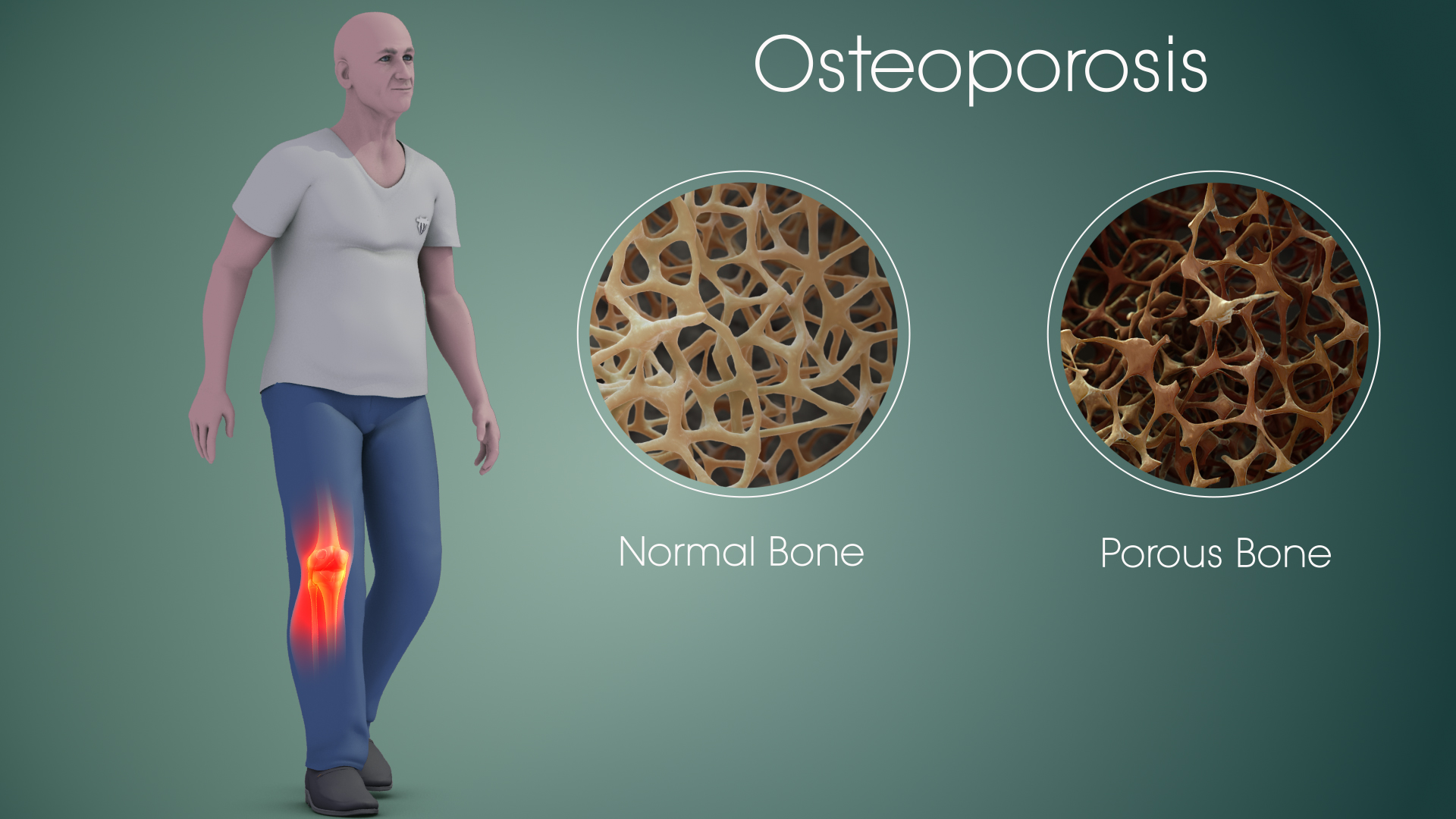 Illustration of a person with a highlighted knee beside labeled comparisons of normal bone and porous bone.