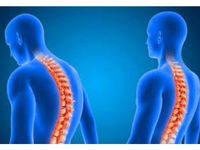 Two side-profile human figures with orange-highlighted spines showing different spinal curves.