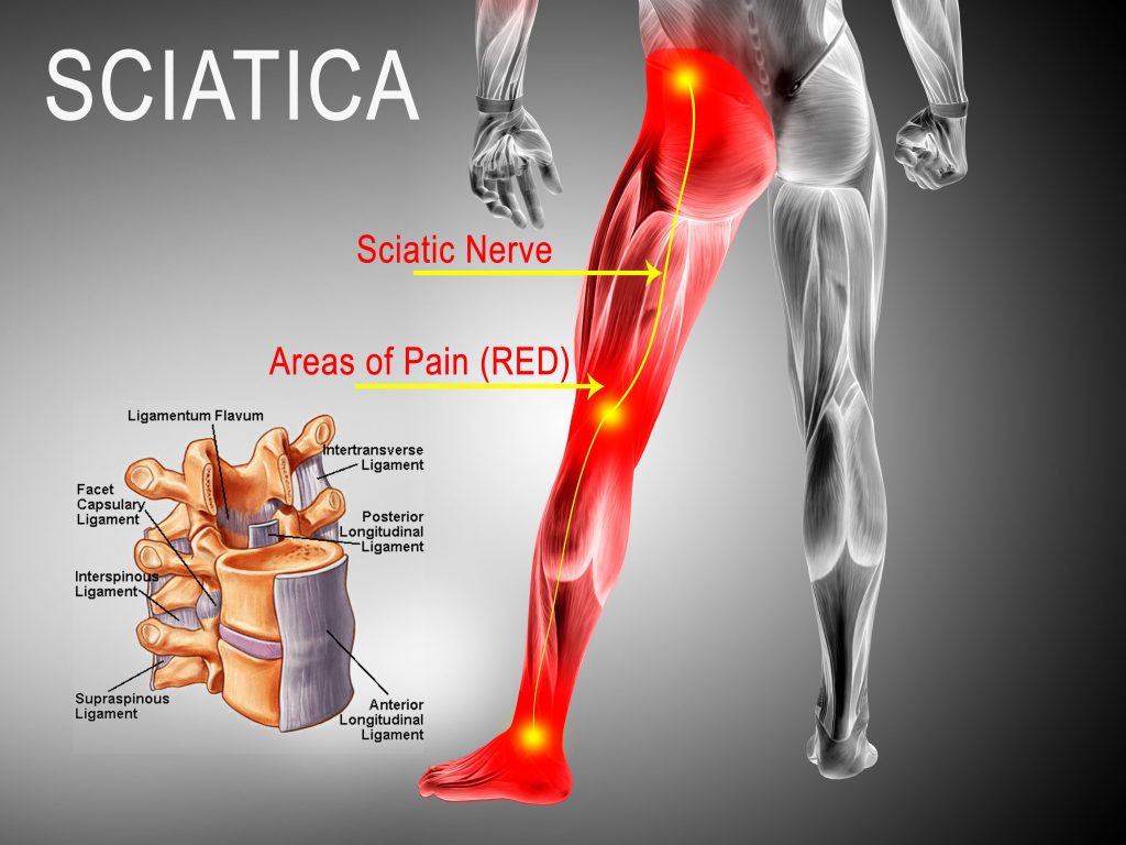Medical illustration showing the sciatic nerve in yellow and red-highlighted areas along the buttock and leg, with a spine