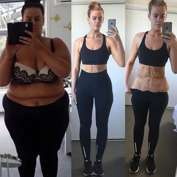 Example of loose skin following weight loss that was too rapid