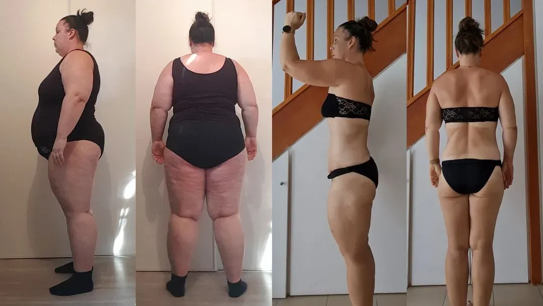 Audrey a réussi à éviter le relâchement cutané malgré une perte de poids extrême de 60 kilos en 2 ans