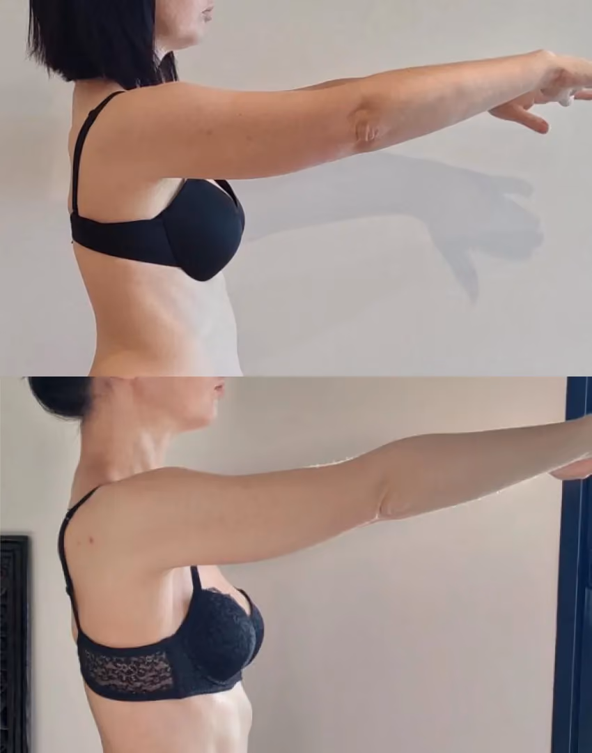 Bras musclés d'une femme qui avait des bras chauve-souris.