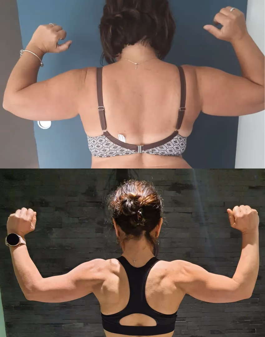 Transformation des bras chauve-souris d'une femme de 40 ans.