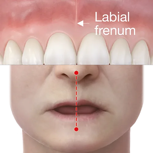 denture
