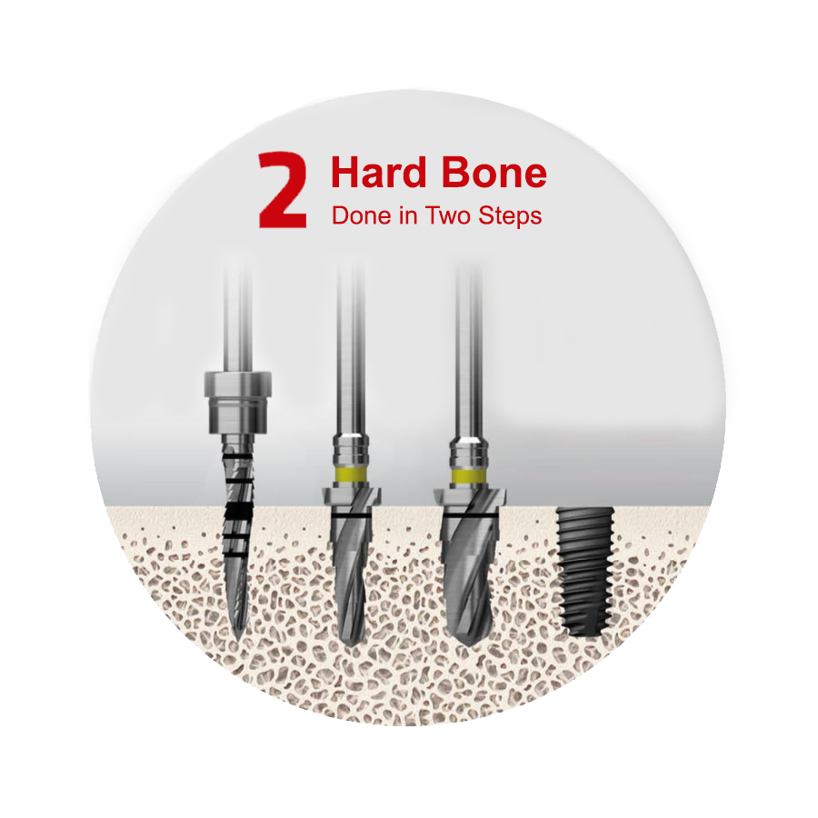 122 Taper  Kit