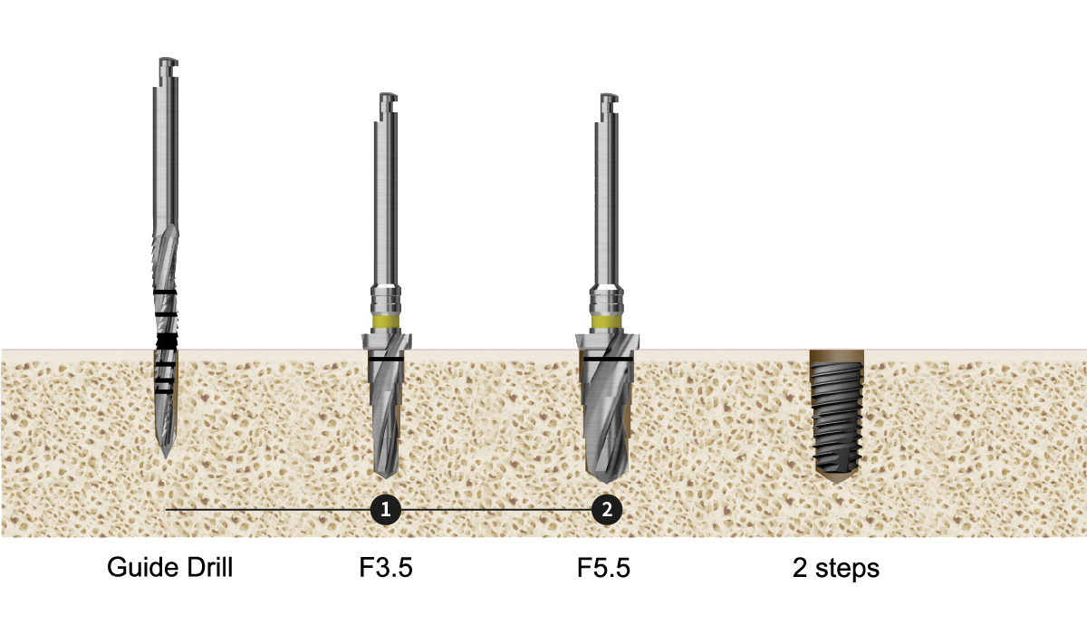 122 Taper  Kit