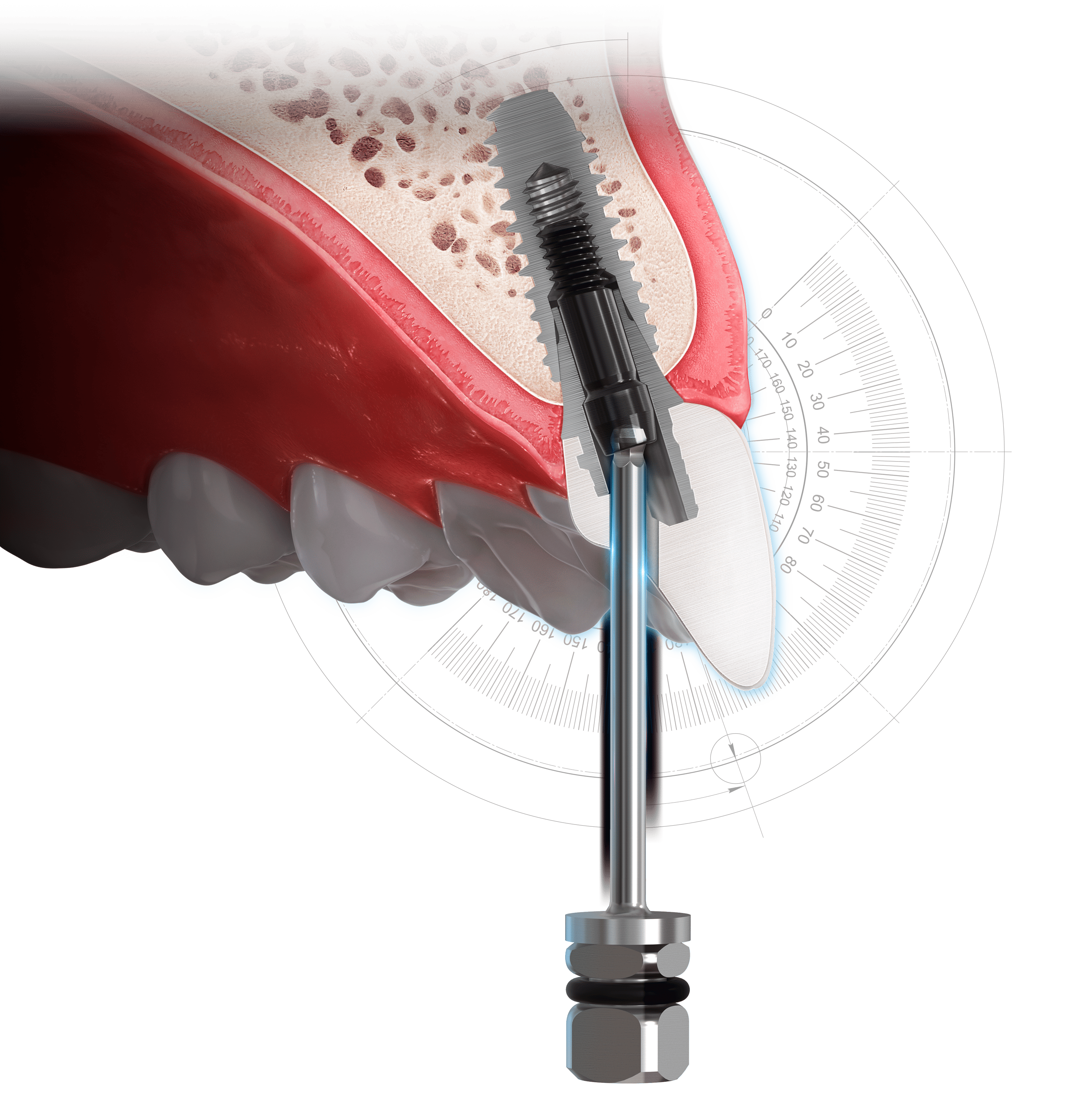 Prosthetic Kit