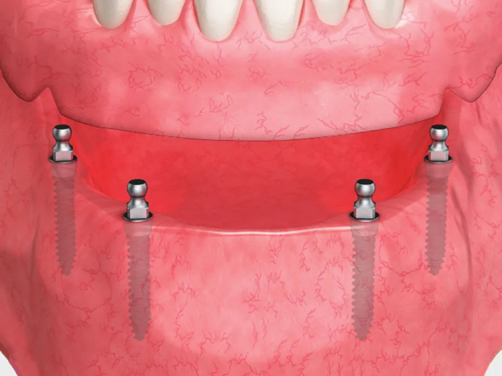 MS Implant