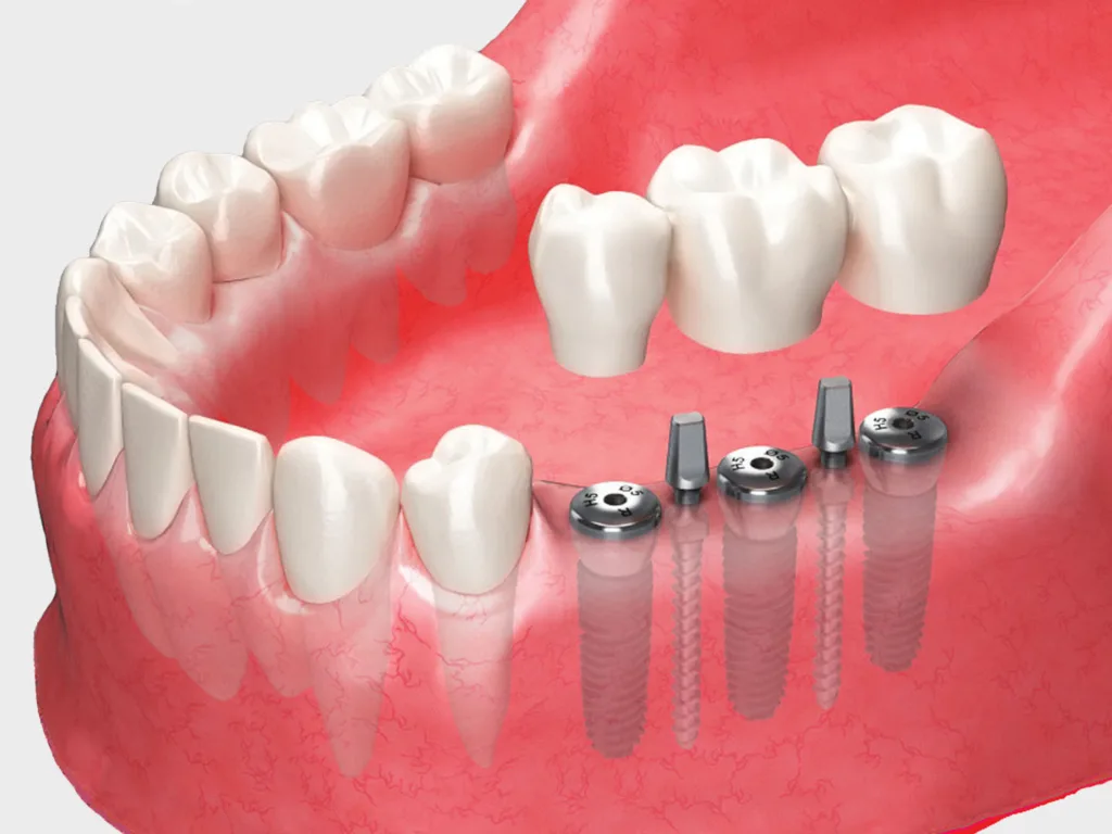 MS Implant