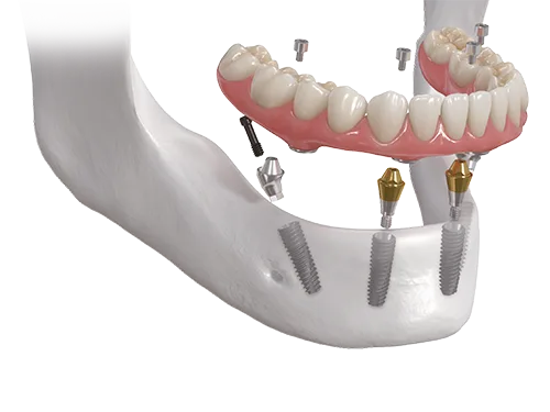 Denture 4U Kit
